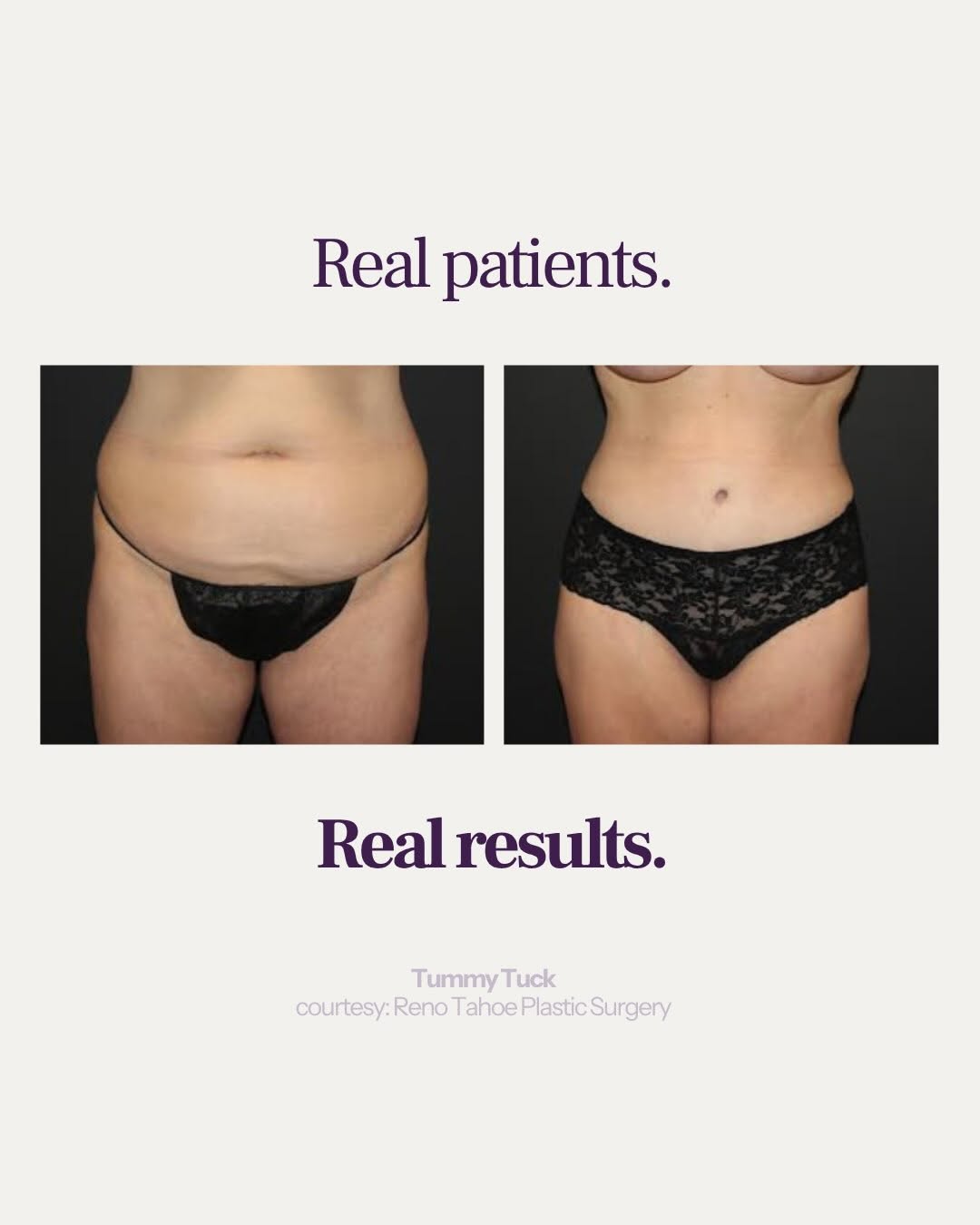 Instagram post by Dr. Tiffany McCormack: Incredible tummy tuck results from none other than @drtiffanymccormack at Reno Tahoe Plastic Surgery ⭐️ Book your consult at the link in bio…