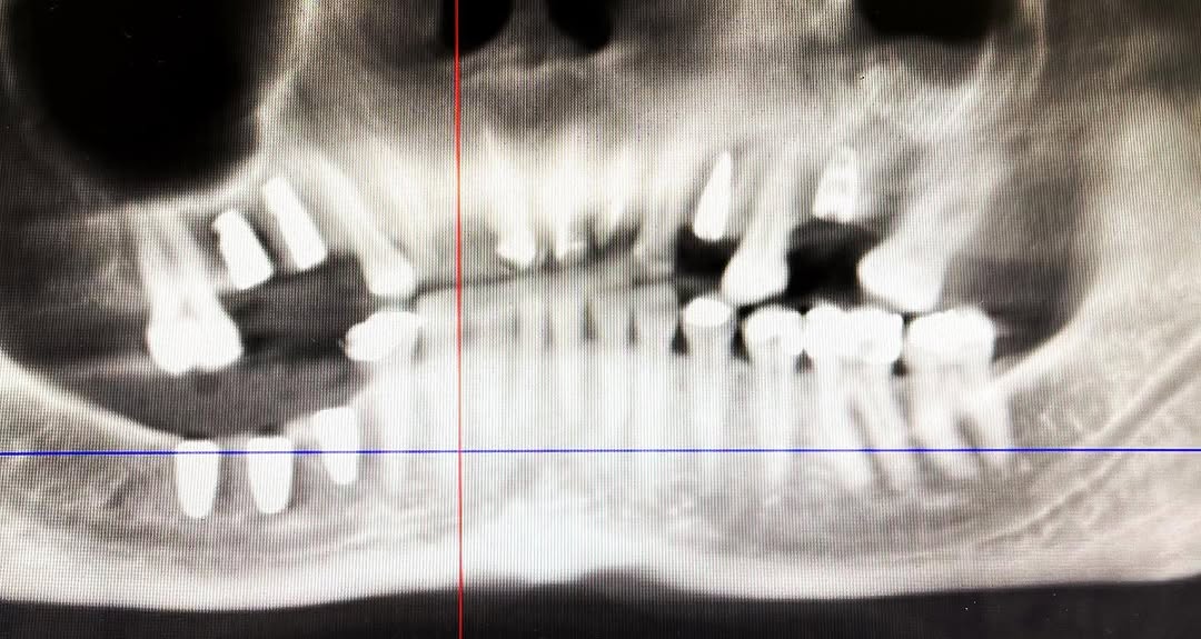 Instagram post by Dr. Timothy Leung: All in a day’s work. 7 implants. Sinus lift. PRF. Great job chief. @chef_omfs @straumann.us #surgicalguide @3shape #implantodontia #dentistr…