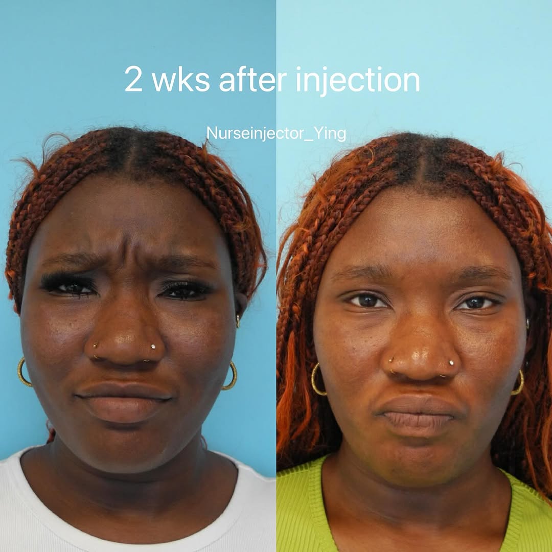 Instagram post by Dr. Timothy M. Greco: ✨ Results speak for themselves—just 1 to 2 weeks post-injection with Botox (neurotoxin). Neurotoxins aren’t just for softening existing line…