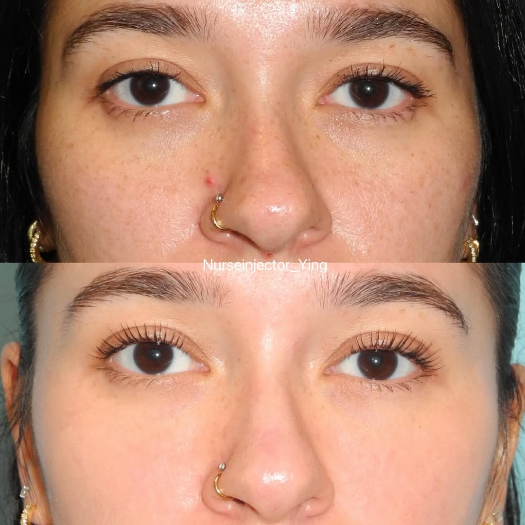 Instagram post by Dr. Timothy M. Greco: Okay, can we talk about this skin transformation?! 🤯🤯🤯 This incredible clarity is after just ONE session of the Greco MD Brightening Boos…