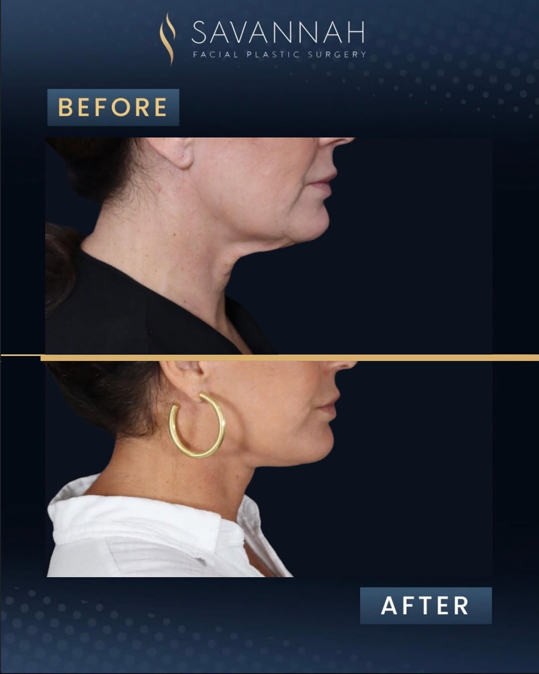 Instagram post by Dr. Timothy Minton: Results by @drtimminton ✨ This lovely patient is 10 months post op from her deep plane neck lift! Deep plane neck lifting allows for structu…
