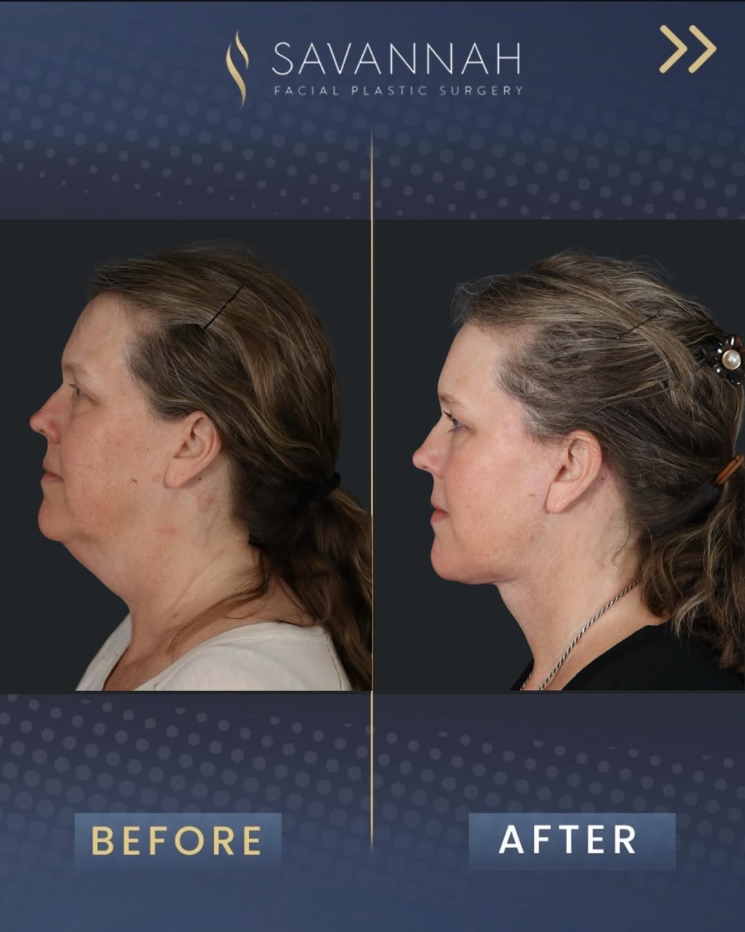 Instagram post by Dr. Timothy Minton: Results by @drtimminton ✨ This sweet patient is 5 months post op from her deep plane facelift, deep plane neck lift, and endoscopic brow lif…