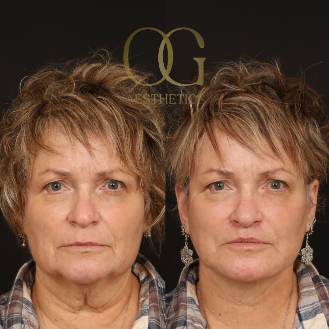 Instagram post by Dr. Timothy Ortlip: My 62 yo patient who underwent Extended #deepplanefacelift #liplift #fattransfertoface to reset and feel rejuvenated again. She had spent ma…