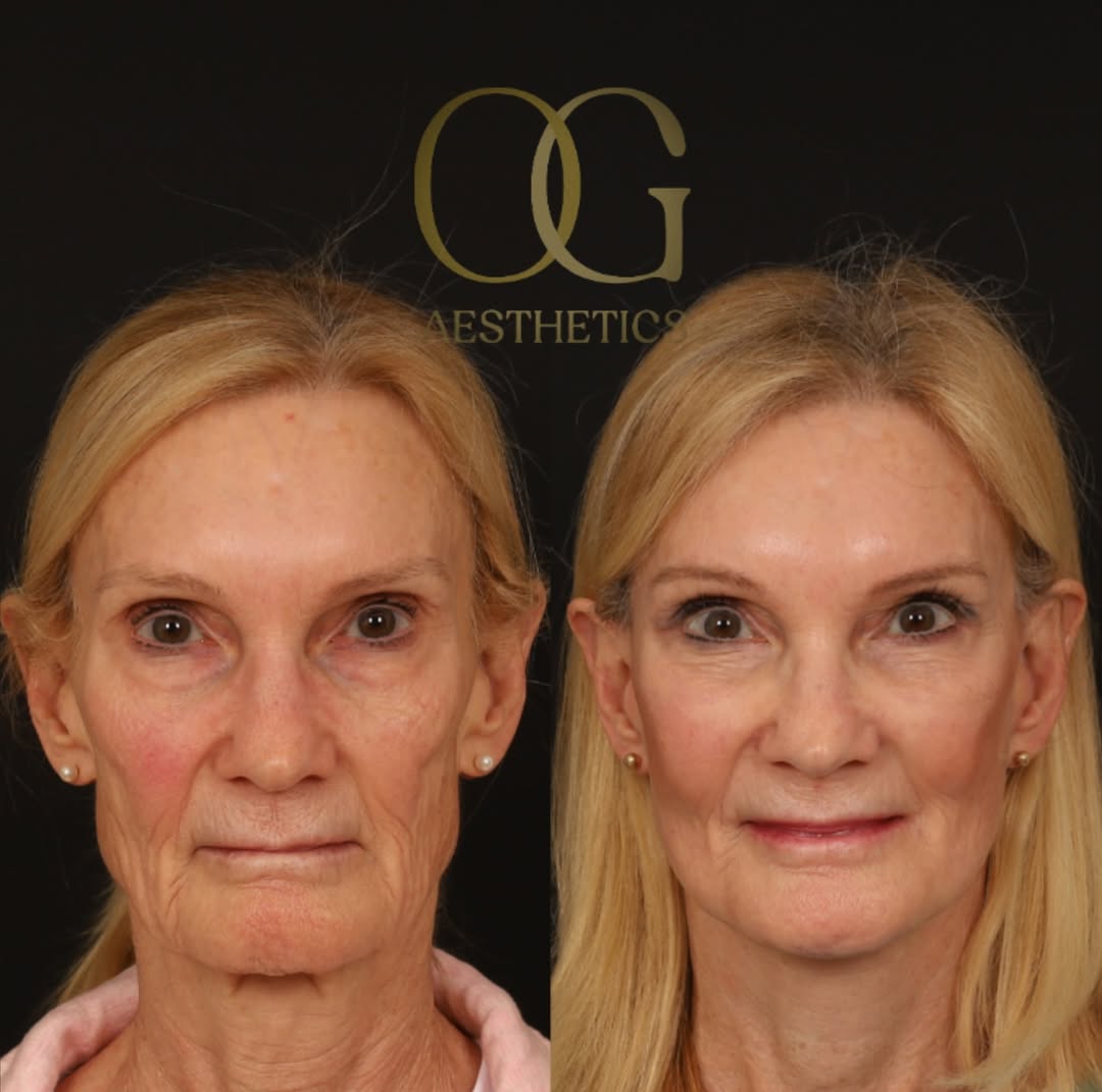 Instagram post by Dr. Timothy Ortlip: Great facelift results start with respect for the skin. Skin isn’t just something to “pull tight.” It’s a living tissue with unique thicknes…
