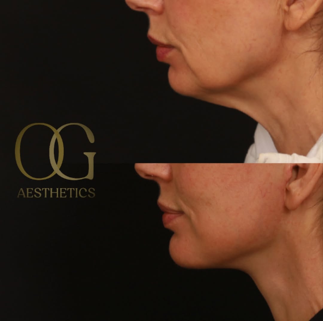 Instagram post by Dr. Timothy Ortlip: The feeling I get when I see patients healed up after their #deepplanefacelift never gets old. Restored sense of one’s self, vitality, natur…