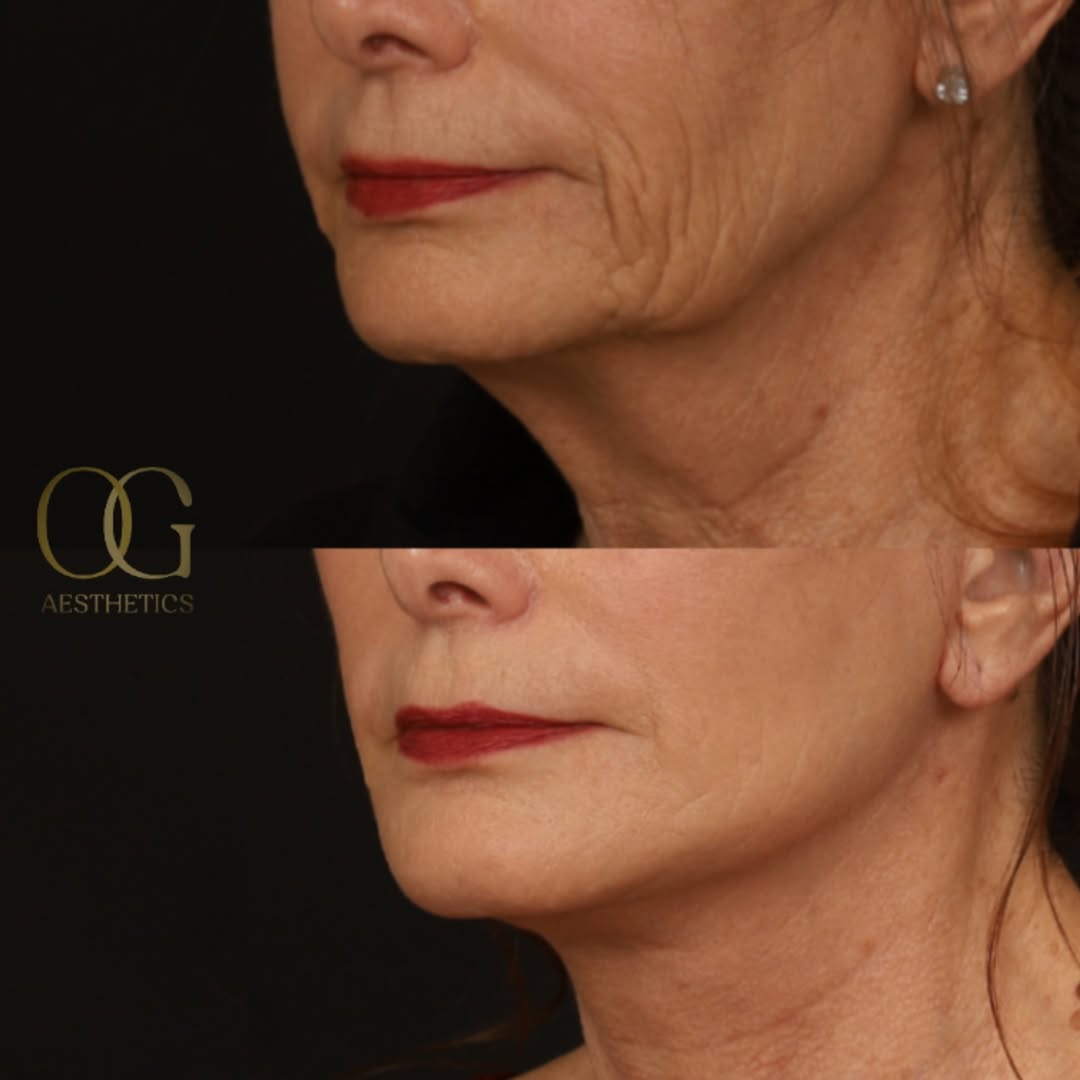 Instagram post by Dr. Timothy Ortlip: Age 64. Three months out from #deepplanefacelift Contours restored, nothing overdone. Healing quietly, showing up beautifully. How many year…