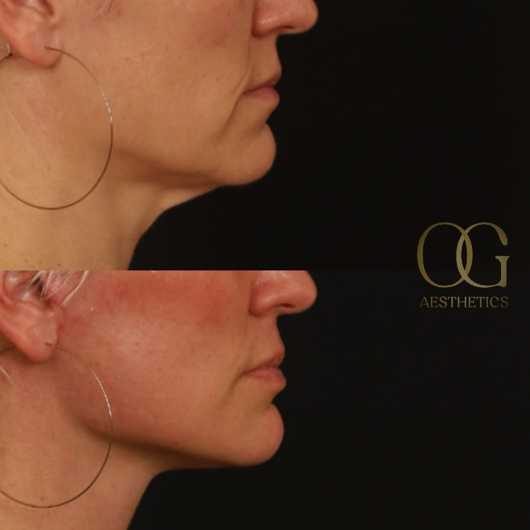 Instagram post by Dr. Timothy Ortlip: Seeing early signs of aging? Non-invasive treatments not helping anymore? Surgery might be worth considering now — and timing matters. Waiti…