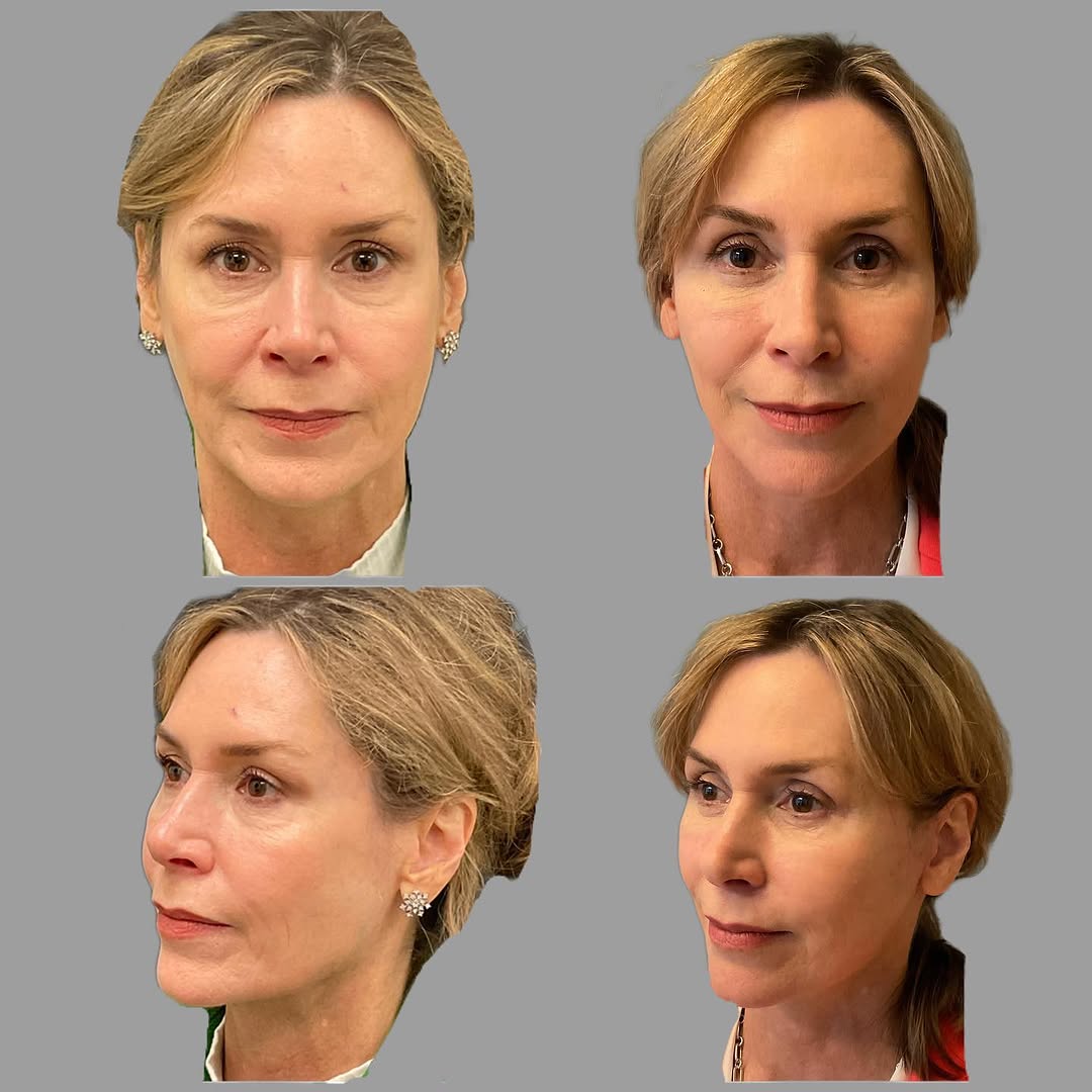 Instagram post by Dr. Timothy Treece: Facelift Friday ✨✨✨ This patient is looking refined and refreshed just one month after her facelift & lower blepharoplasty. Accentuating my …