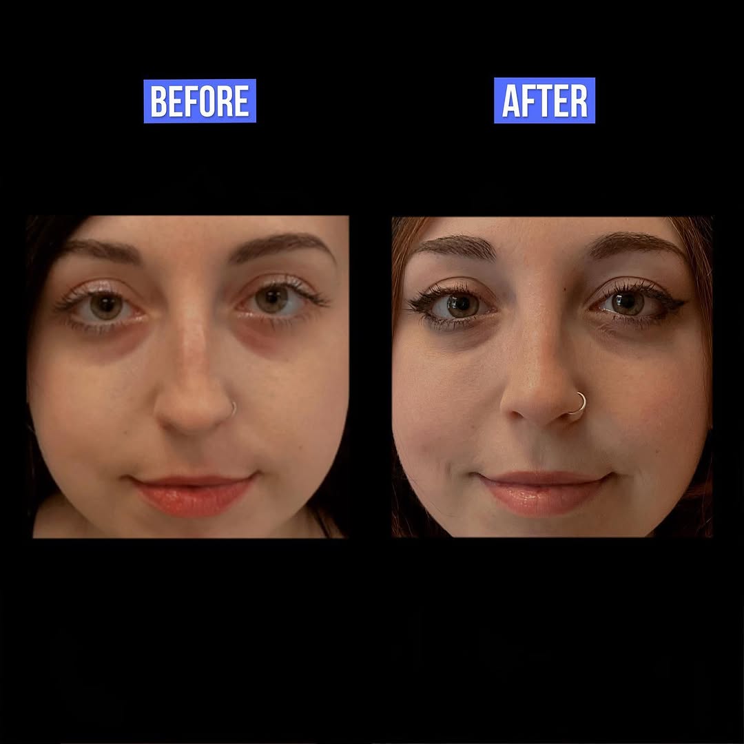 Instagram post by Dr. Timothy Treece: Rhinoplasty results are in!!! ✅ Grab your favorite bag of chips and scroll to see how beautifully this patient’s nose healed. She is 5 month…