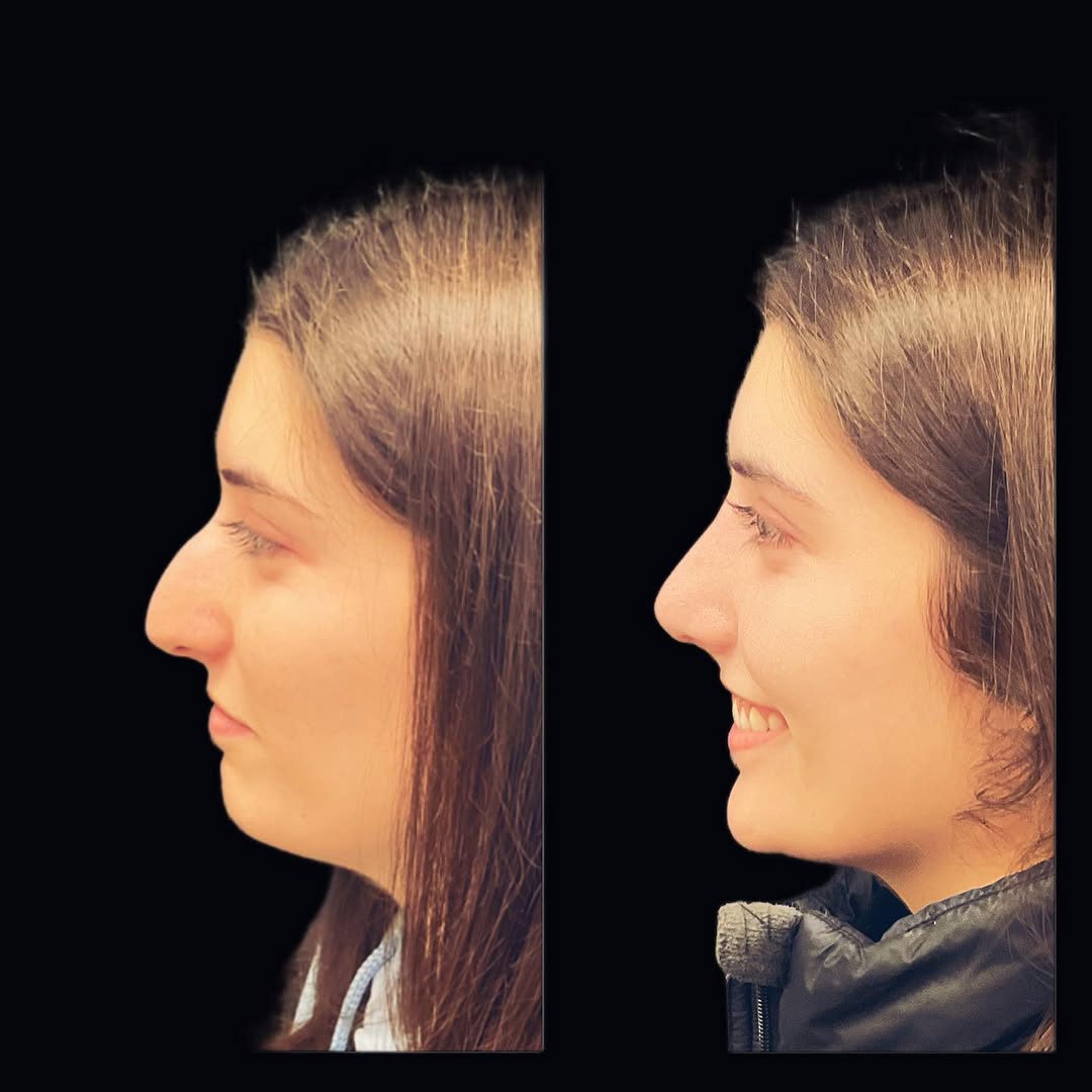 Instagram post by Dr. Timothy Treece: This patient was one month post Rhinoplasty when these photos were taken. Some minor swelling was expected on the day of her visit. However,…