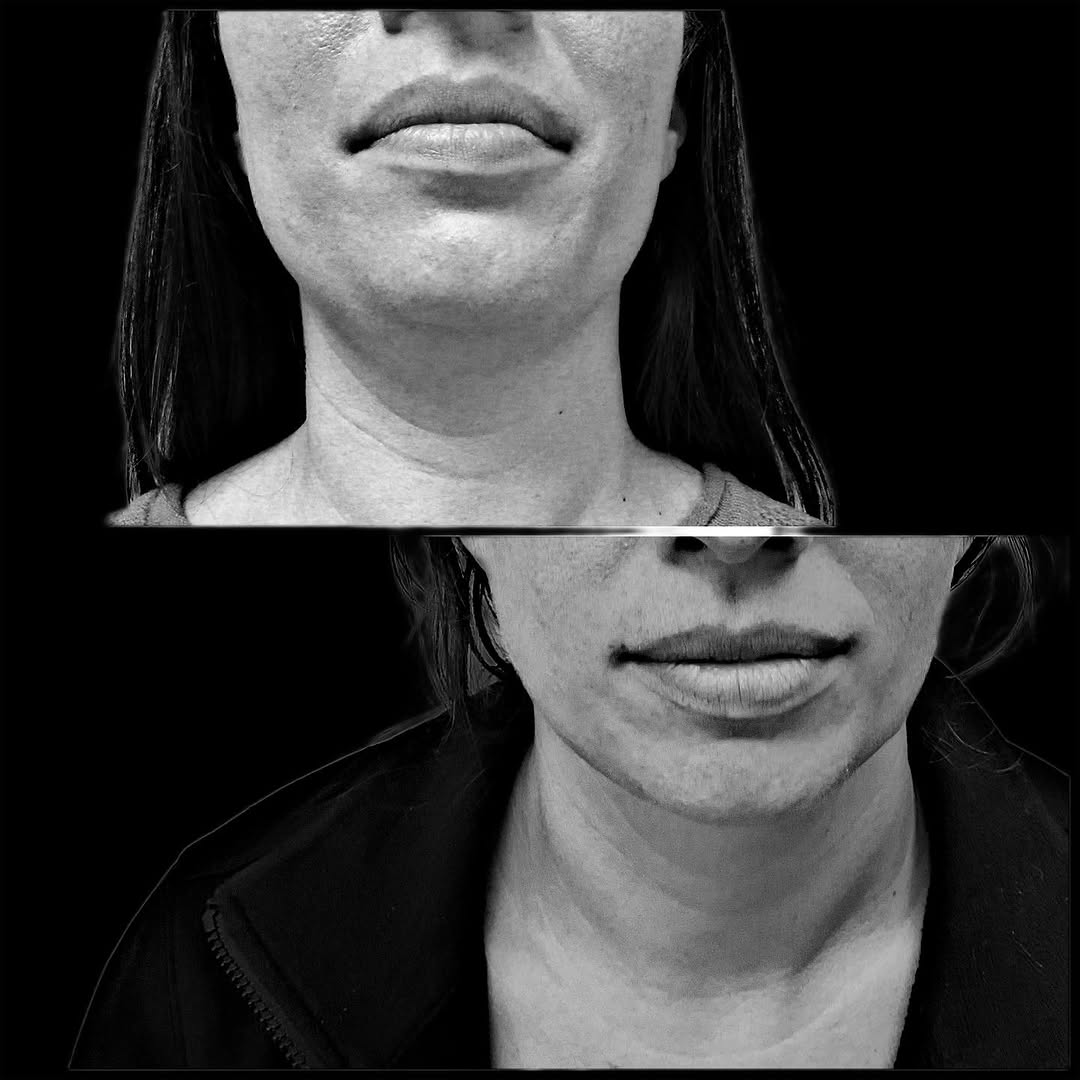 Instagram post by Dr. Timothy Treece: This patient had a necklift with submental liposuction and FaceTite to her jawline. This procedure takes about 2.5 hours and the results can…