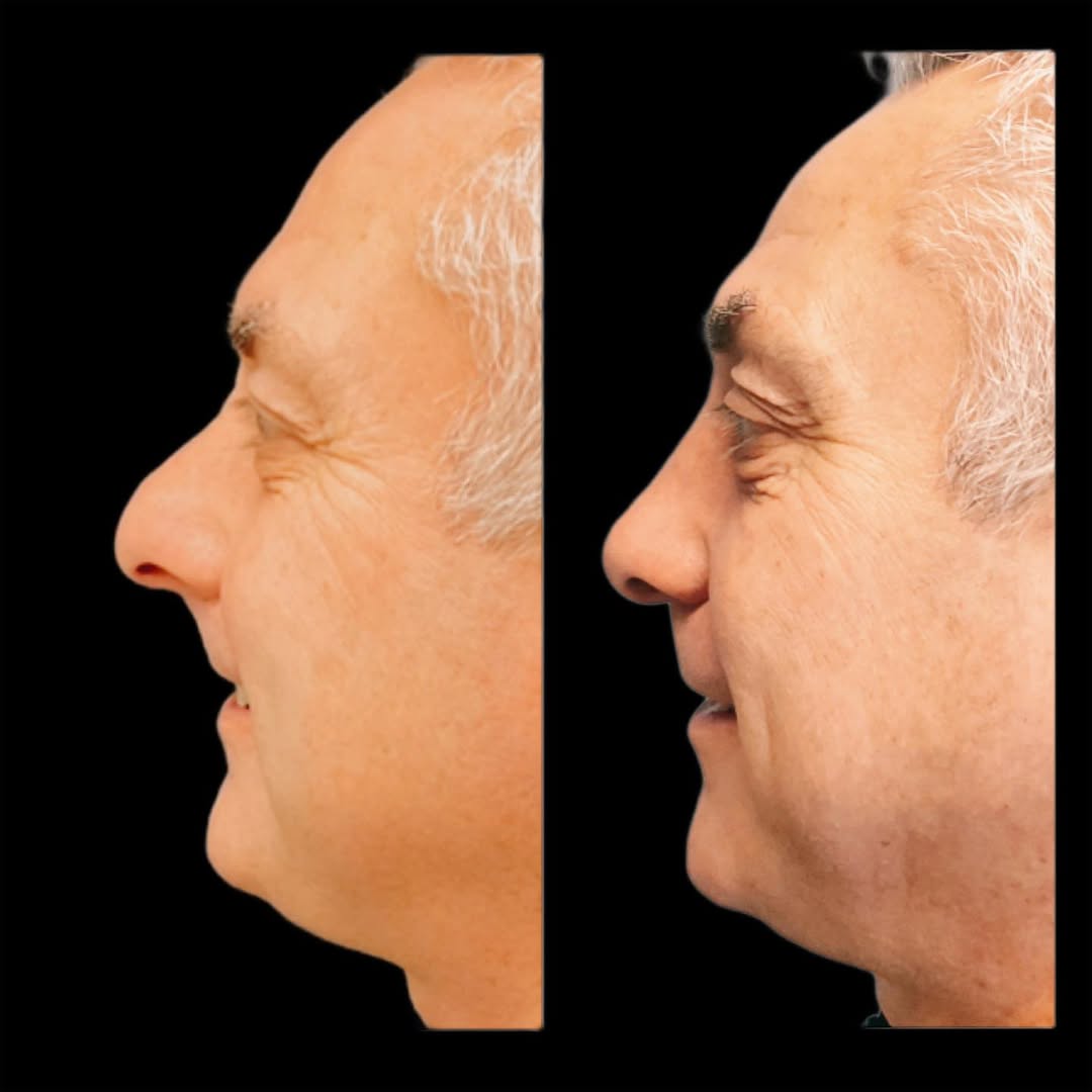 Instagram post by Dr. Timothy Treece: This patient booked his rhinoplasty with me so he clearly nose what’s up! 😎 He had his consult in December, booked in January, and these ph…