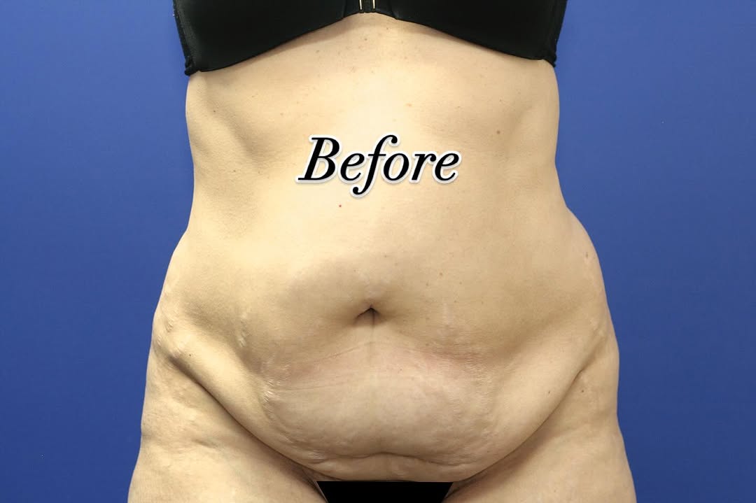 Instagram post by Dr. Tito Vasquez: Tummy tuck, or abdominoplasy, is a common post pregnancy procedure that both tightens your abdominal wall and the excess skin, making you fi…