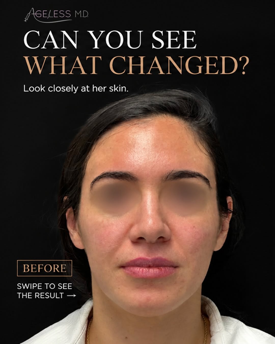 Instagram post by Dr. TJ Tsay: What can one Sylfirm X session do? 👀 ✨ Smoother texture ✨ Clearer, more even tone ✨ Less visible redness ✨ Softer look of melasma ✨ Real gl…