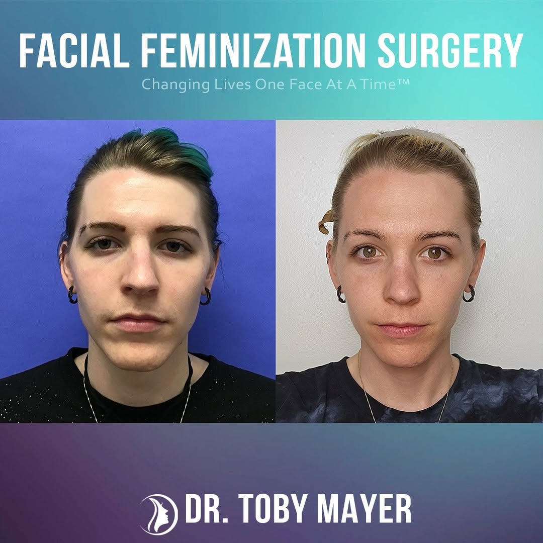 Instagram post by Dr. Toby Mayer: Facial Feminization Surgery (FFS) is a powerful step in aligning your outer appearance with your true self, and it's never too early or too …