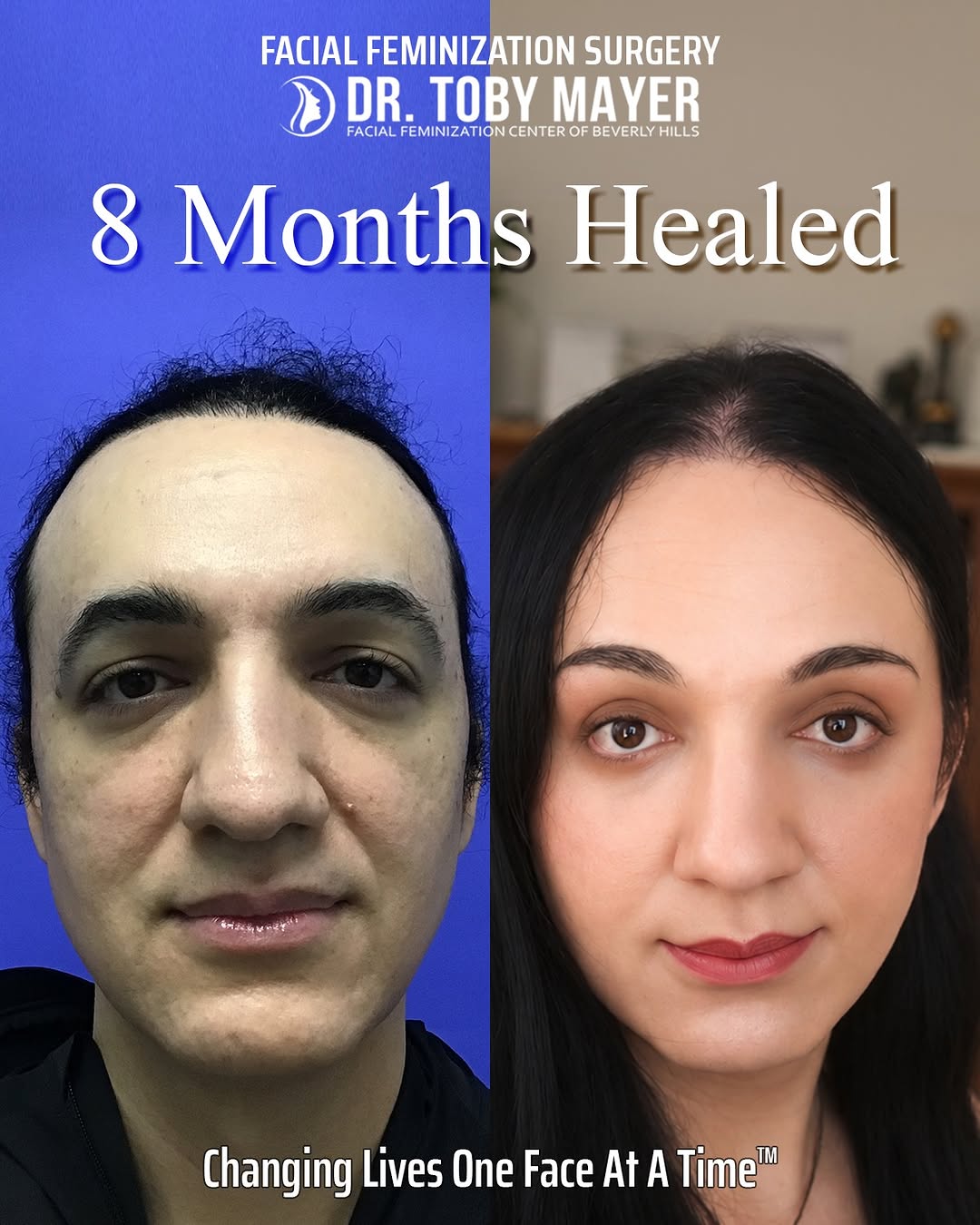 Instagram post by Dr. Toby Mayer: CERES - 8 Months of Healing Watching features soften and settle during facial feminization recovery requires patience, but seeing the final …