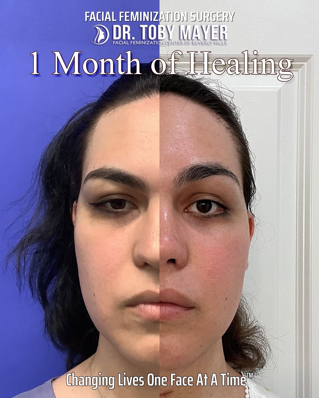 Instagram post by Dr. Toby Mayer: Valerie - 1 Month Healed Here are Valerie's results, showing how much everything softens once healing takes hold. Dr. Mayer focused on creat…