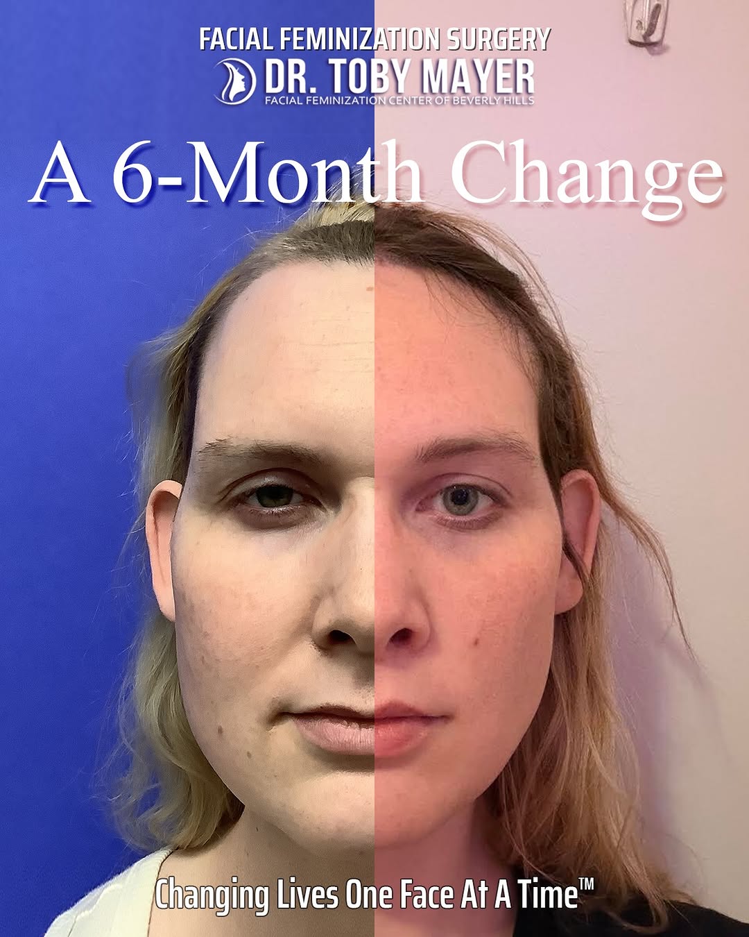 Instagram post by Dr. Toby Mayer: ASHLEY -- 6 MONTHS Ashley's results show how nicely features continue to soften and settle over time. Dr. Mayer focused on bringing balance …
