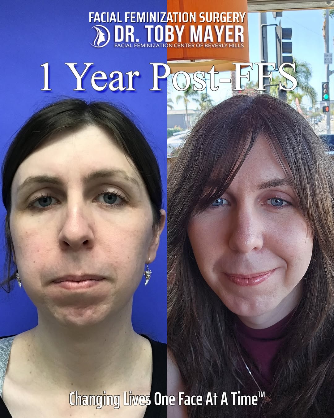 Instagram post by Dr. Toby Mayer: ERIN - 1 Year Post-Op Reaching the one year mark is a major milestone in facial feminization, and seeing how naturally Erin's features have …