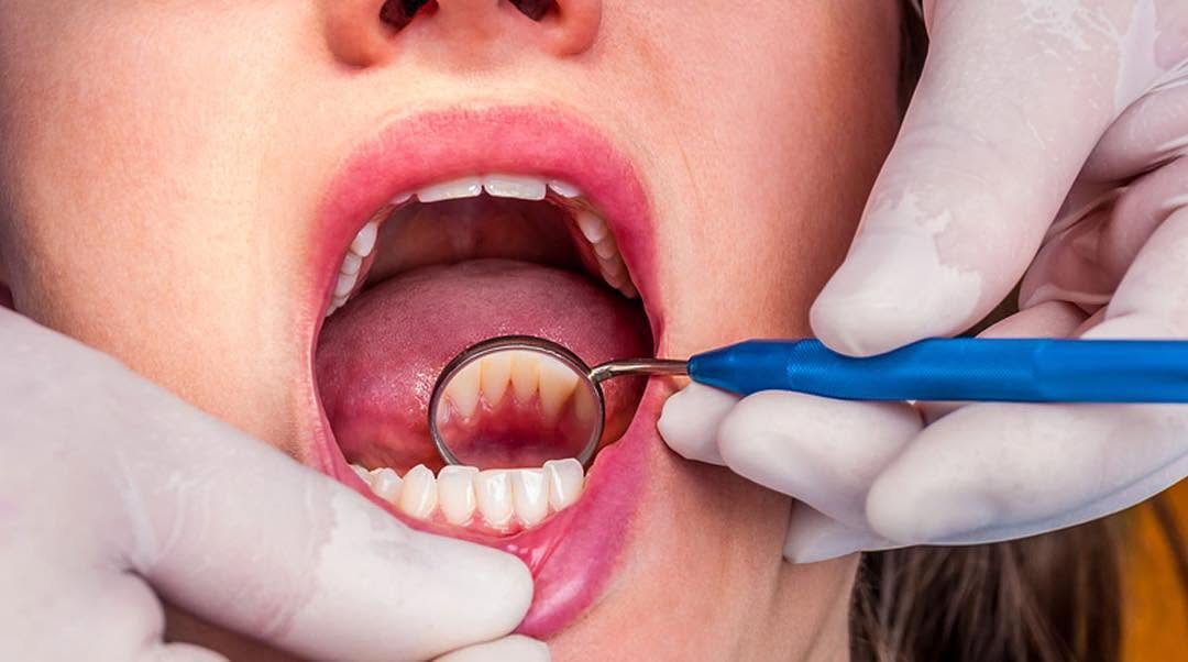 Instagram post by Dr. Todd B. Barsky, DDS: Prophylaxis is the most common teeth cleaning procedure. Plaque forms from sugar and simple carbs on the surface of your teethβit is the stiβ¦