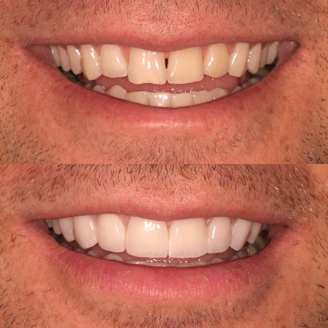 Instagram post by Dr. Todd B. Barsky, DDS: What better way to start a Monday morning than with an amazing smile transformation!!ππΌππΌ This patient came into our office unhappy withβ¦