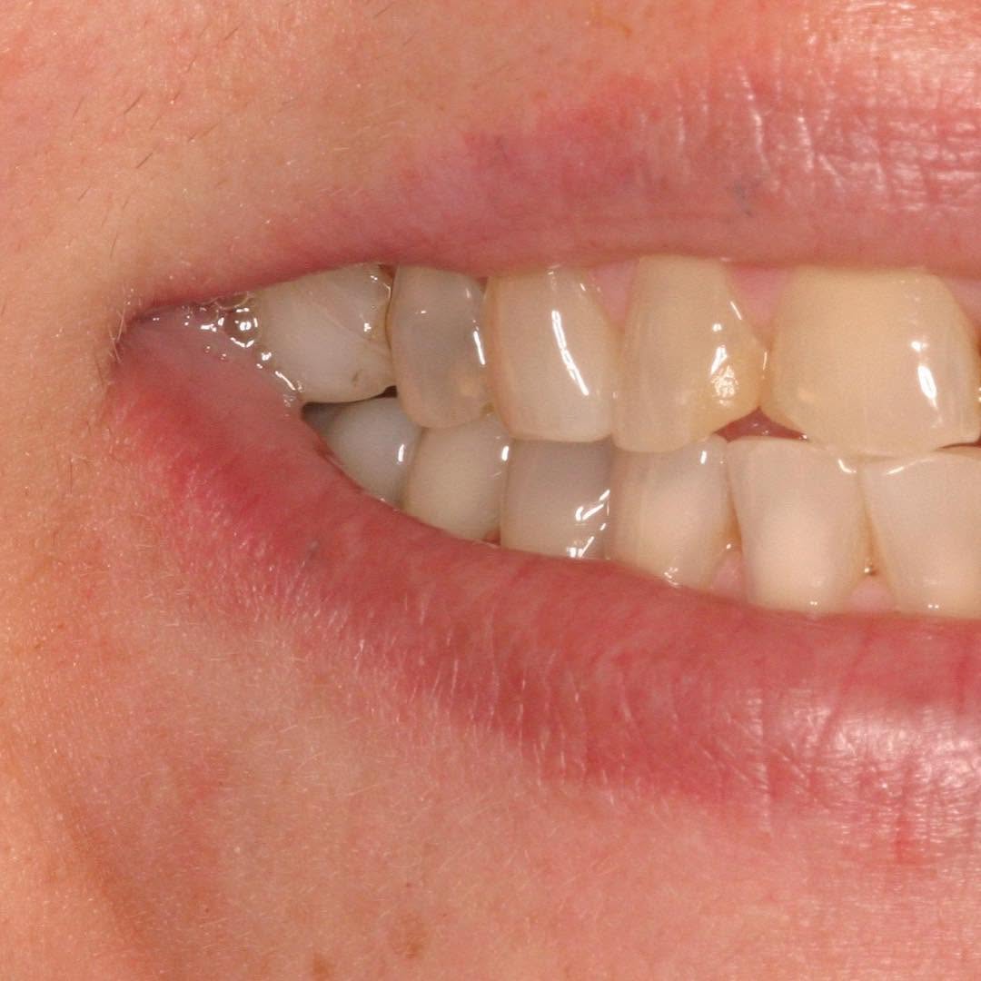 Instagram post by Dr. Todd B. Barsky, DDS: Swipe left to see this great smile transformation! πSchedule a consultation with our Board Certified Prosthodontist, Dr. Todd Barsky to seeβ¦