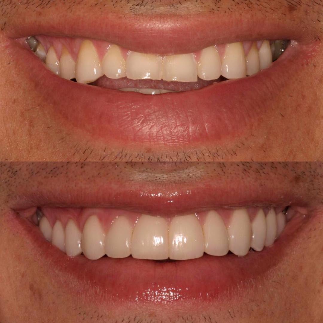 Instagram post by Dr. Todd B. Barsky, DDS: Another AWESOME smile transformation. ππ―This patient was experiencing severe sensitivity on his front teeth due to abrasion from grinding β¦
