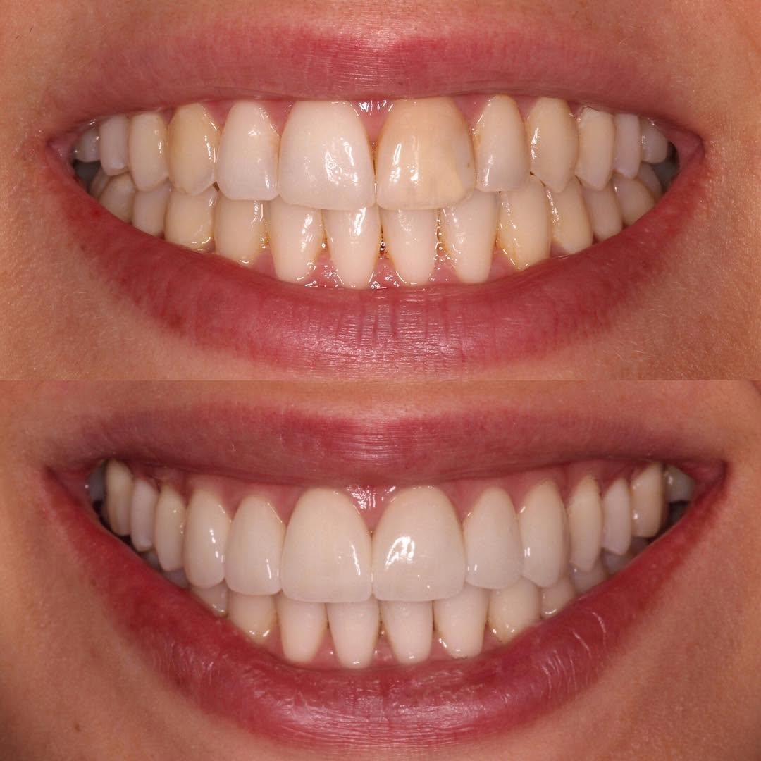 Instagram post by Dr. Todd B. Barsky, DDS: Amazing transformation! π€©π―This patientβs smile makeover was accomplished with 6 custom made porcelain veneers for a glowing transformationβ¦