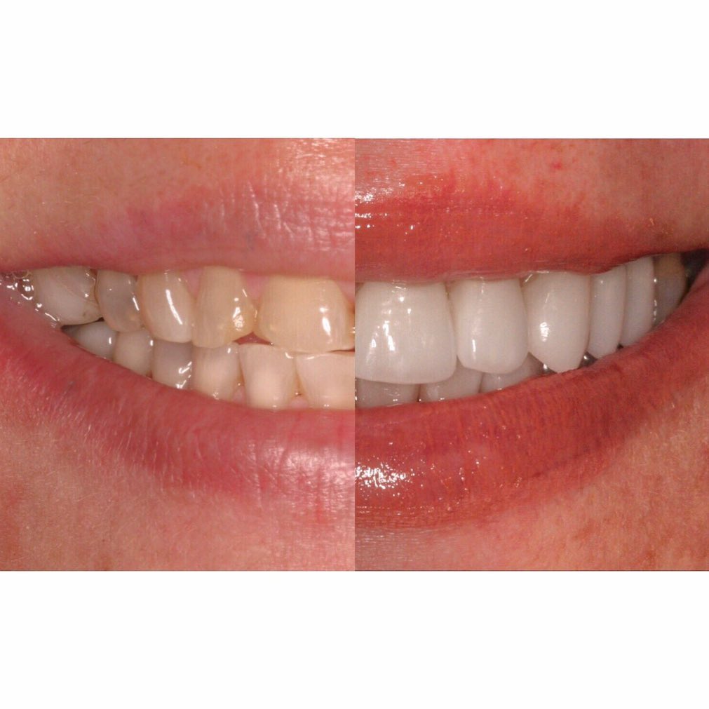 Instagram post by Dr. Todd B. Barsky, DDS: A side by side comparison of one of our previous posts. Here you can see the transformation more clearly and how much more glowing and healtβ¦
