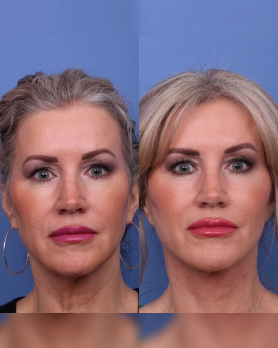 Instagram post by Dr. Todd Christopher Hobgood: ✨ Facelift Transformation ✨ A deep plane facelift is the gold standard of care for patients looking to improve their #turkeyneck, #jowls, an…