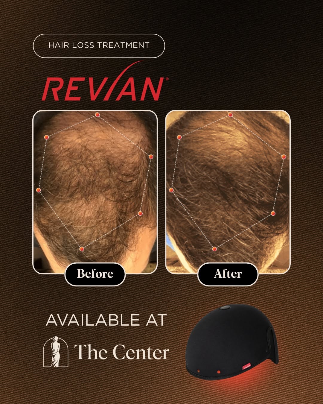 Instagram post by Dr. Todd M. Van Ye: Fuller hair in just 10 minutes per day! It doesn't get any easier than @revianred .