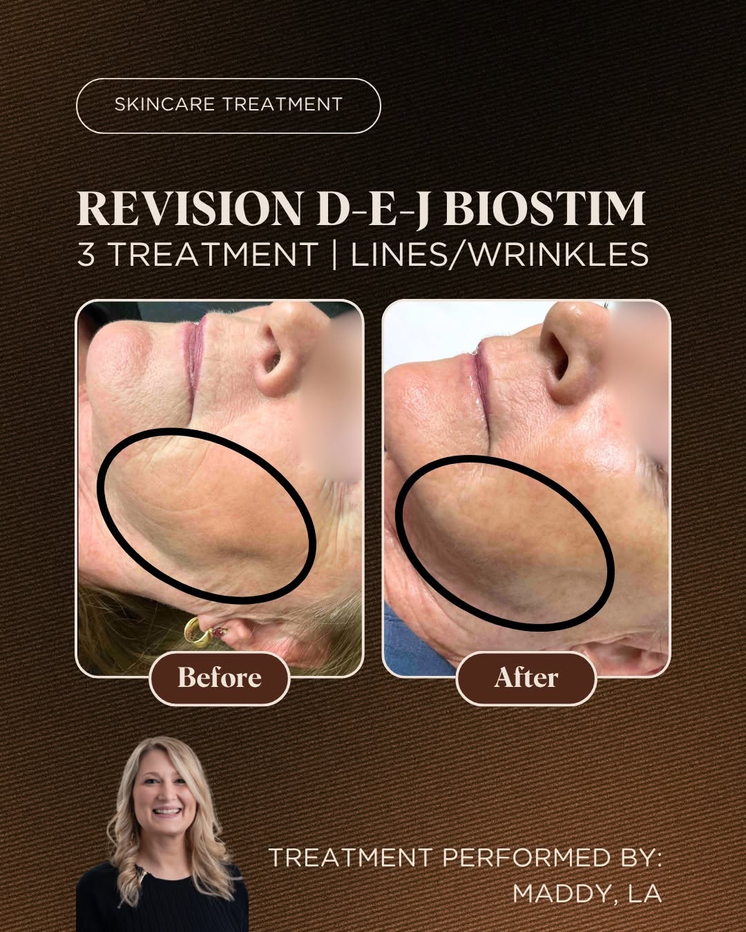 Instagram post by Dr. Todd M. Van Ye: The @revisionskincare DEJ BioStim treatment has quickly become a favorite around here. And for good reason. Take a look at these results @ma…