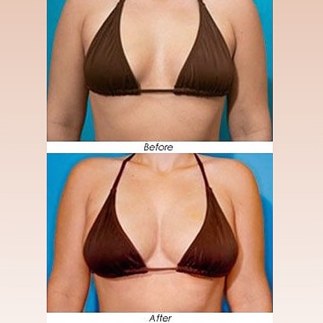 Instagram post by Dr. Todd Malan: Why get implants when you can have an all-natural breast augmentation using unwanted fat and stem cells from your own body? Fat transfer bre…