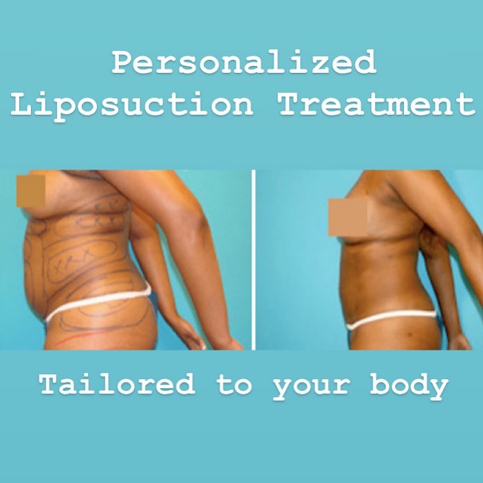 Instagram post by Dr. Todd Malan: Dr. Malan can create a personalized liposuction treatment tailored to your body using state of the art laser liposuction, body-jet liposucti…