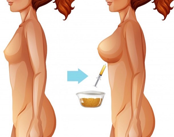 Instagram post by Dr. Todd Malan: Natural looking, fuller breasts using harvested stem cells and fat tissue from your own body. For questions about fat transfer breast augmen…