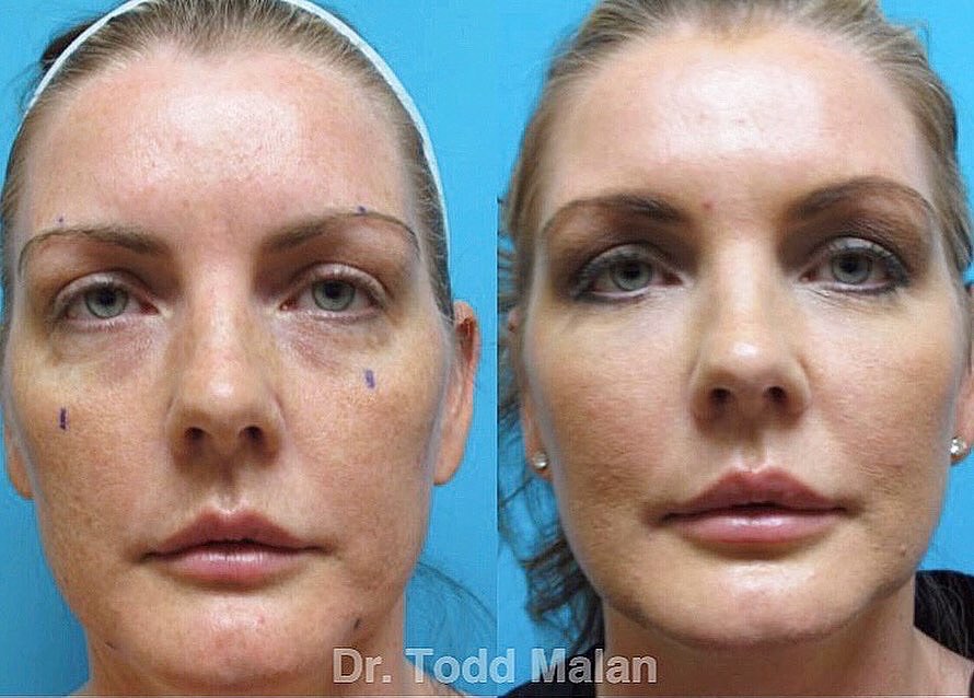 Instagram post by Dr. Todd Malan: Our innovative Fat Transfer Facelift Treatment is a non-surgical procedure that uses your body’s own fat, combined with adult stem cells (fo…
