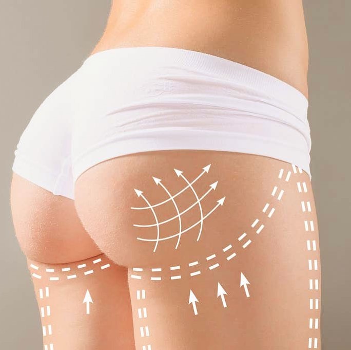 Instagram post by Dr. Todd Malan: Our Fat Transfer Butt Lift procedure is a natural way to enhance and create a shapelier butt by transferring your own unwanted fat from one …