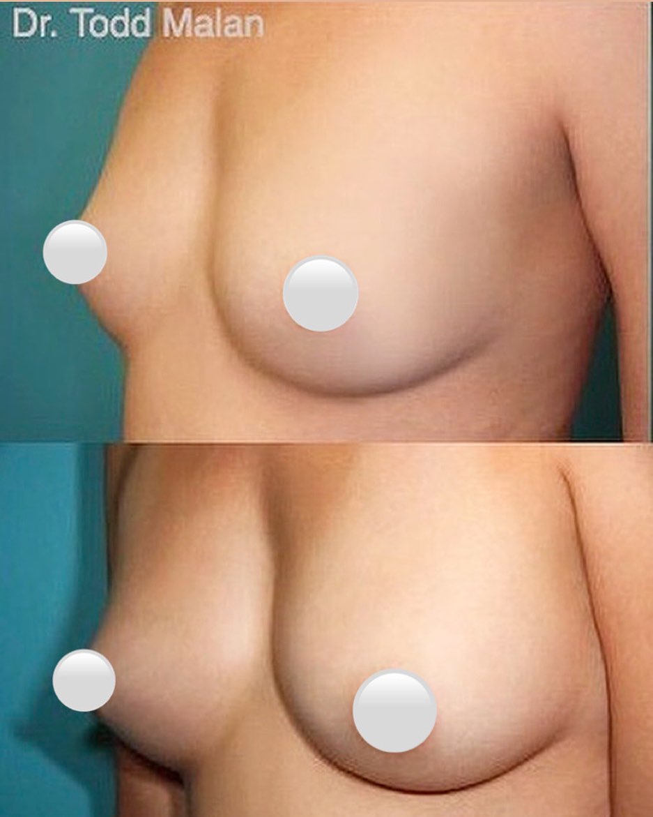 Instagram post by Dr. Todd Malan: Fat Transfer to the breast is the process of taking excess, unwanted fat from one part of the body and injecting it into the breasts to achi…