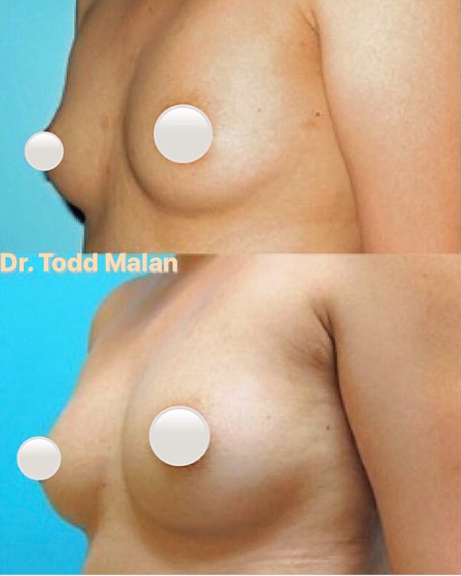 Instagram post by Dr. Todd Malan: For women who don't want implants but would like fuller, shapelier breasts, our Fat Transfer Breast Augmentation procedure has quickly becom…