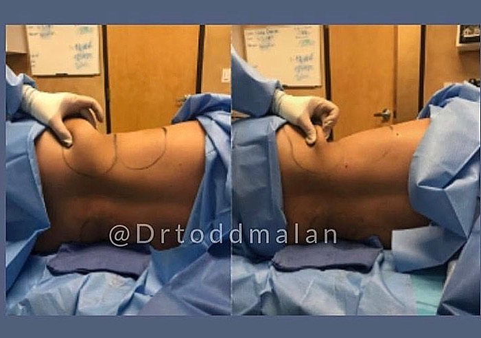 Instagram post by Dr. Todd Malan: Dr. Malan can create a personalized liposuction treatment tailored to your body using state of the art laser liposuction, body-jet liposucti…