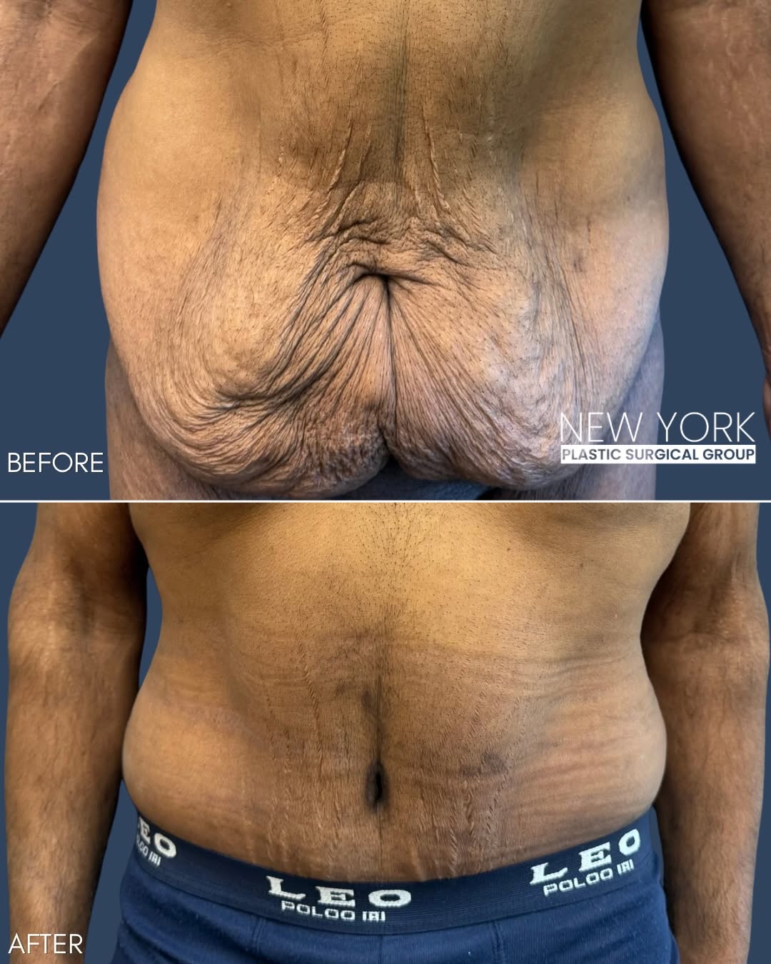 Instagram post by Dr. Tommaso Addona: After an incredible 140-pound weight loss, this patient came to @drabdelflores with excess skin of the lower abdomen that was impacting both…