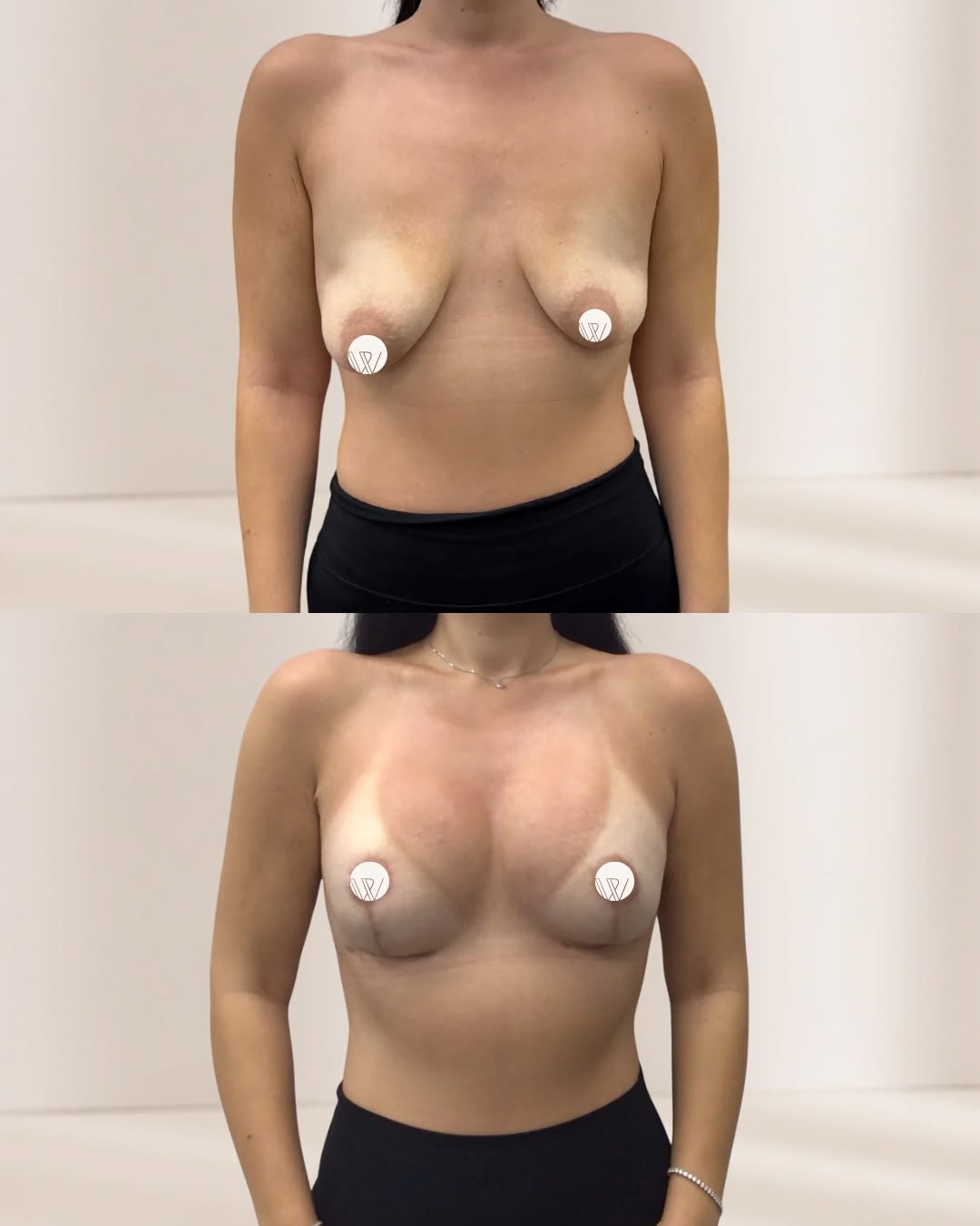 Instagram post by Dr. Tony W. Watt: For her, size wasn’t her main goal… She wanted lift, fullness, and a more centered position first. Significant weight loss often changes bre…