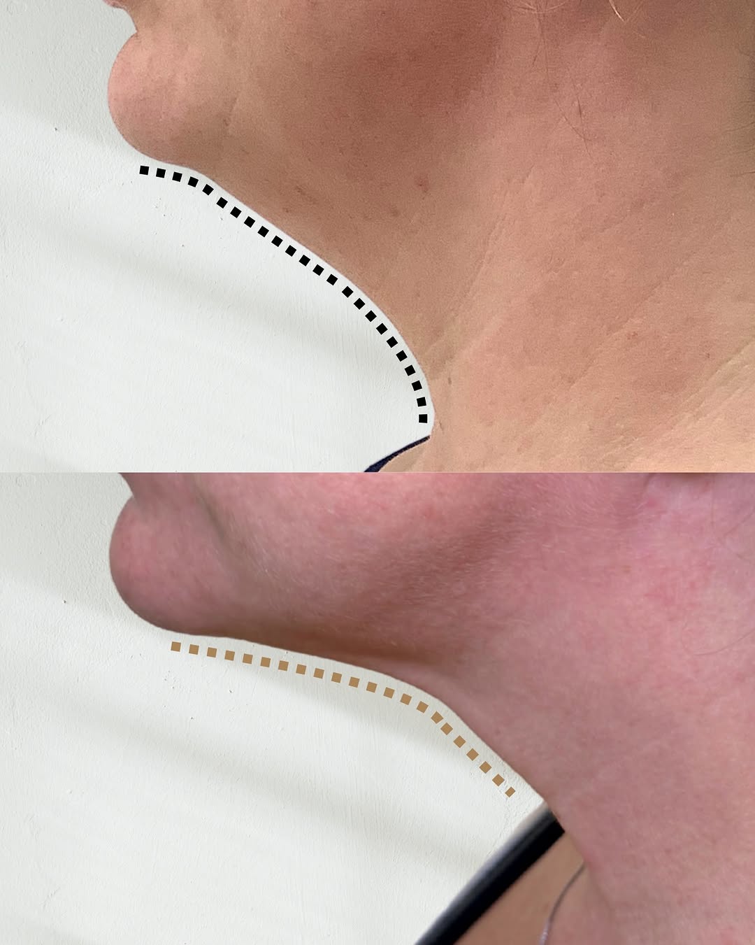 Instagram post by Dr. Tony W. Watt: Stubborn under-chin fullness? Meet neck lipo 💉👏 Sub-mental fullness (Otherwise known as the fullness beneath the chin), is often driven by…
