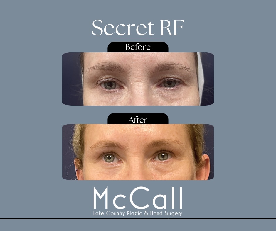 Instagram post by Dr. Tracy E. McCall: The eyes can be one the most difficult areas to treat but not with Secret RF! This low downtime will have you looking refreshed in as little…
