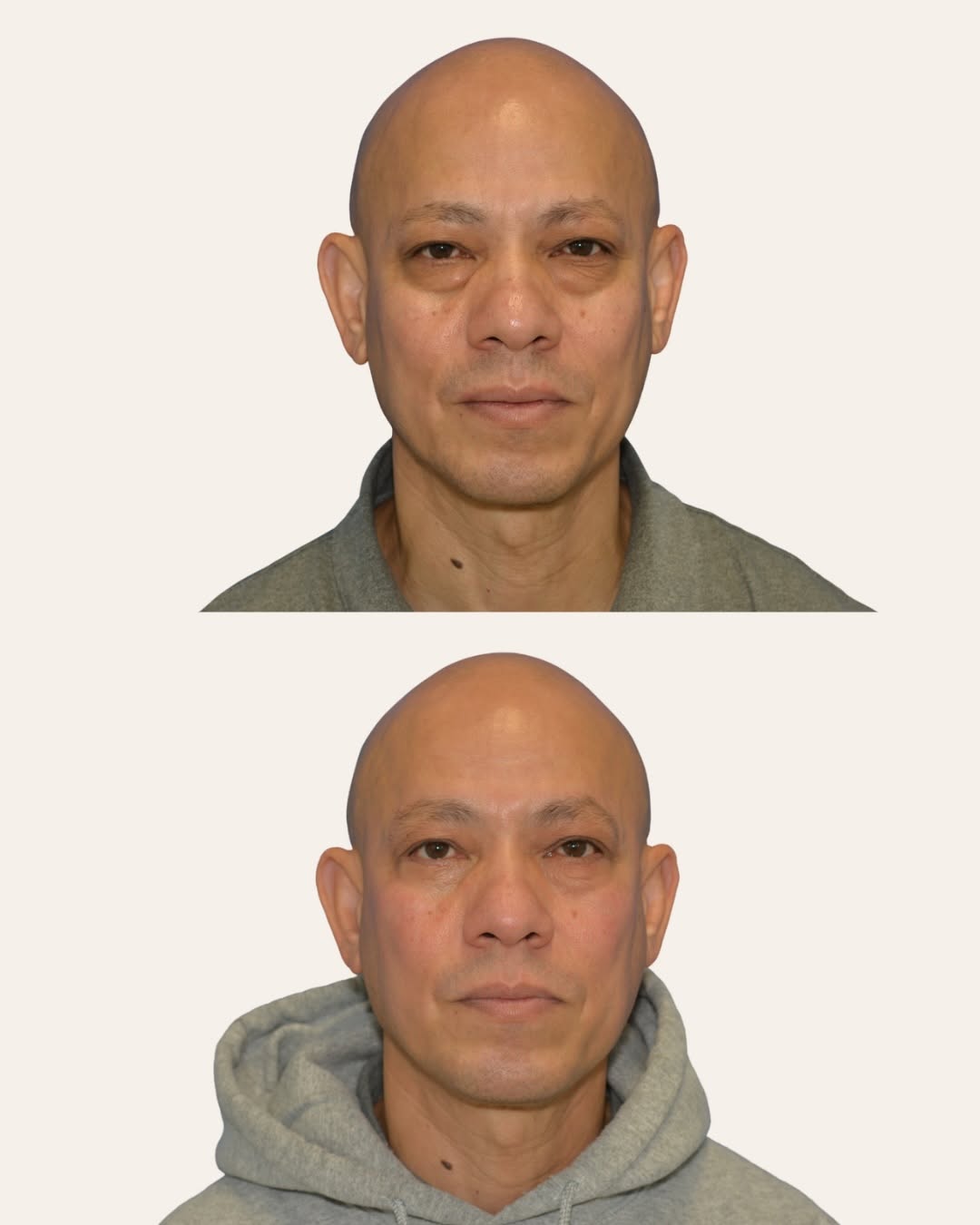 Instagram post by Dr. Trang Vo-Nguyen: Lower Bleph Before & After ✨ This patient came to us with severe under-eye bags and dark circles. We treated them with a lower blepharoplast…