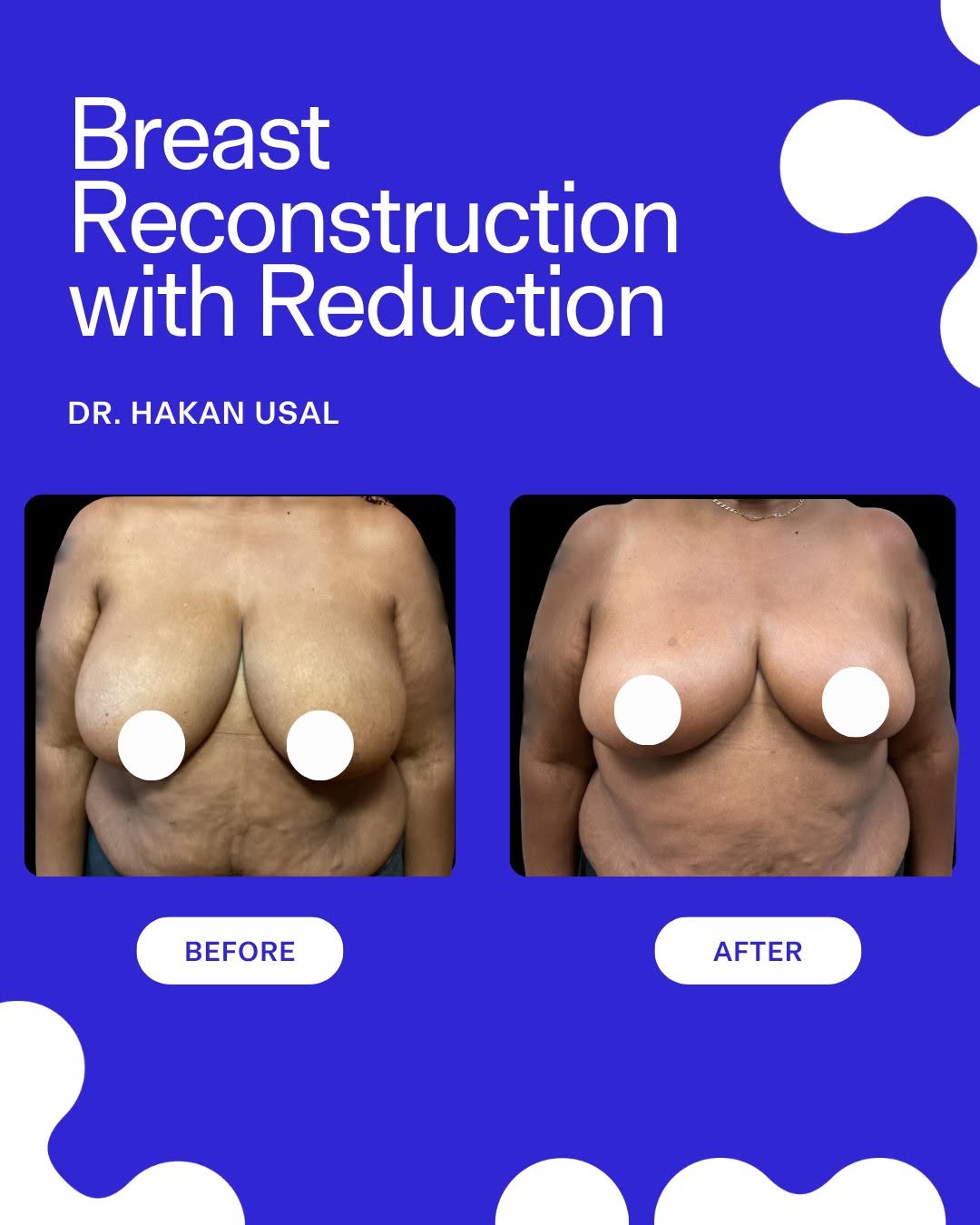 Instagram post by Dr. Tushar R. Patel: Breast reconstruction with reduction, performed by Dr. Hakan Usal. This patient underwent reconstruction on the left side following breast c…