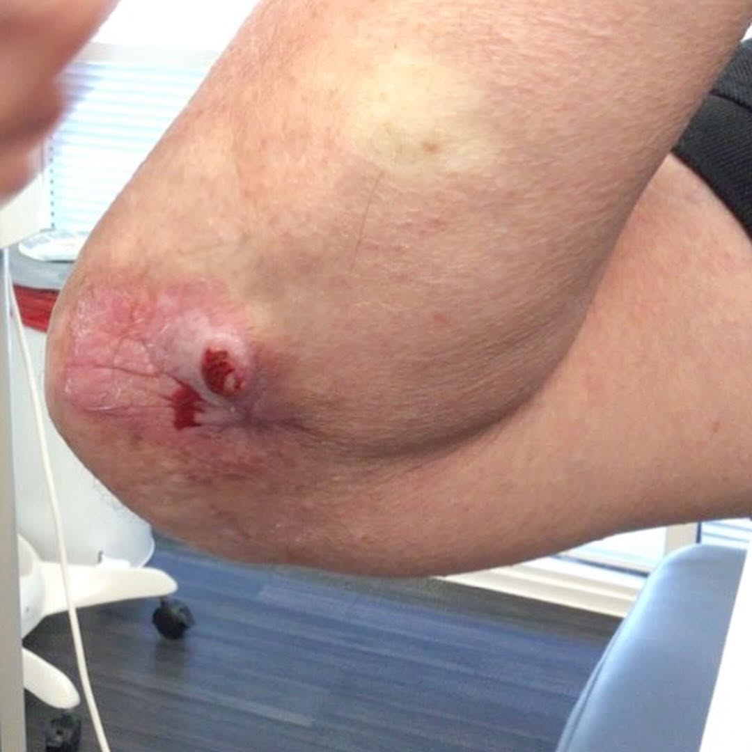 Instagram post by Dr. Tyler Moss, DO: Large squamous cell carcinoma excision done by Dr. Pehoushek! End your year on a good note and come on in to get your skin checked! #skincar…
