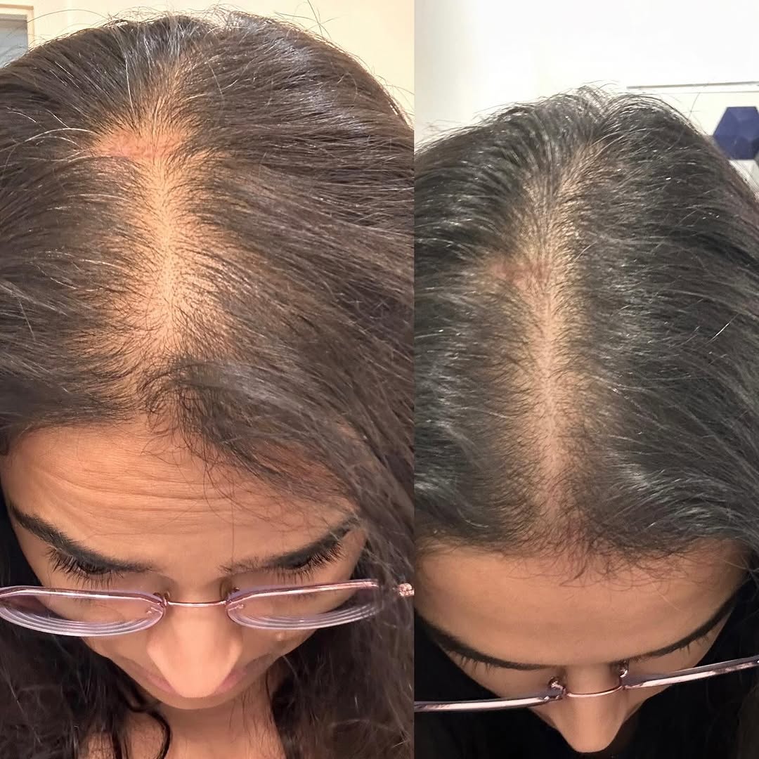 Instagram post by Dr. Tyler Moss, DO: Hair loss transformation➡️ These photos are 3 months apart after being on a combination of oral Spironolactone and oral Minoxidil!! 💆🏾♀️ …