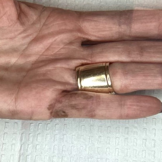 Instagram post by Dr. Tyler Moss, DO: Malignant melanoma can appear anywhere on your skin…even on your finger. This brave patient took action and received a skin graft to fully r…