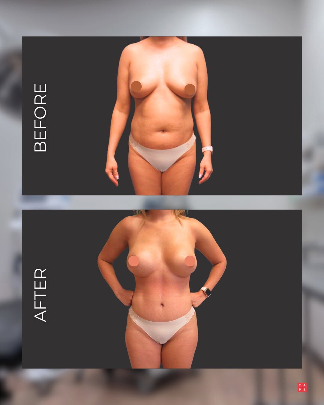 Instagram post by Dr. Tyler Sbrocchi: Confidence looks good on everyone✨ Our Mommy Makeover procedures are tailored to restore your shape, enhance your confidence, and help you f…